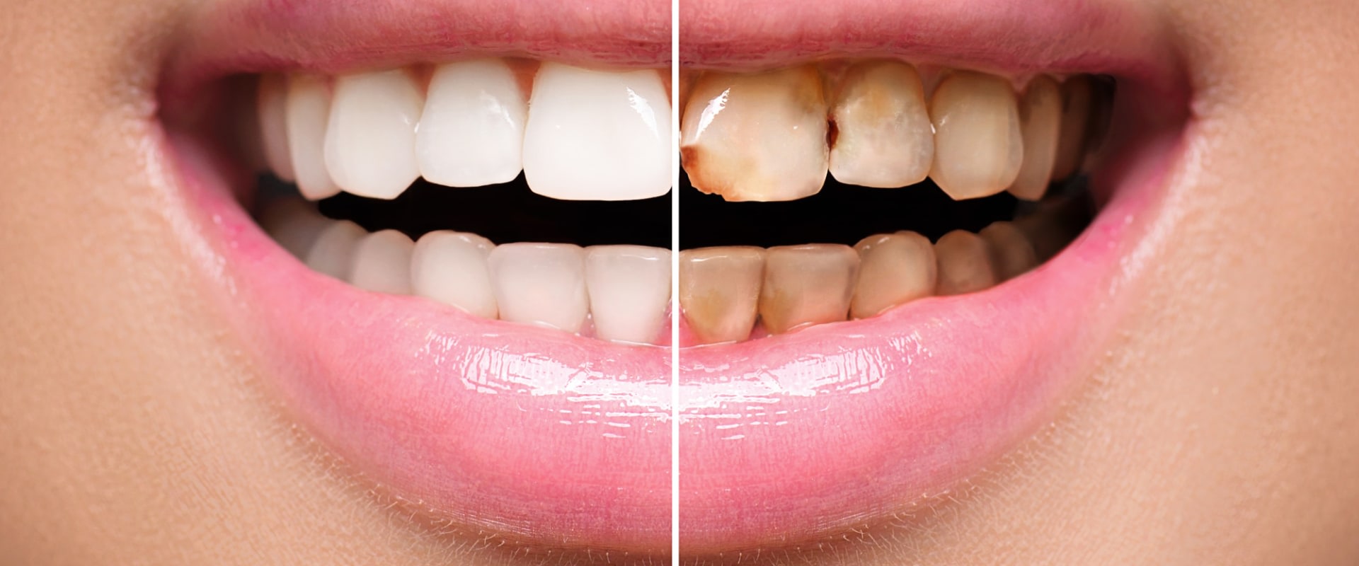 How Long Do Veneers Last On Your Teeth