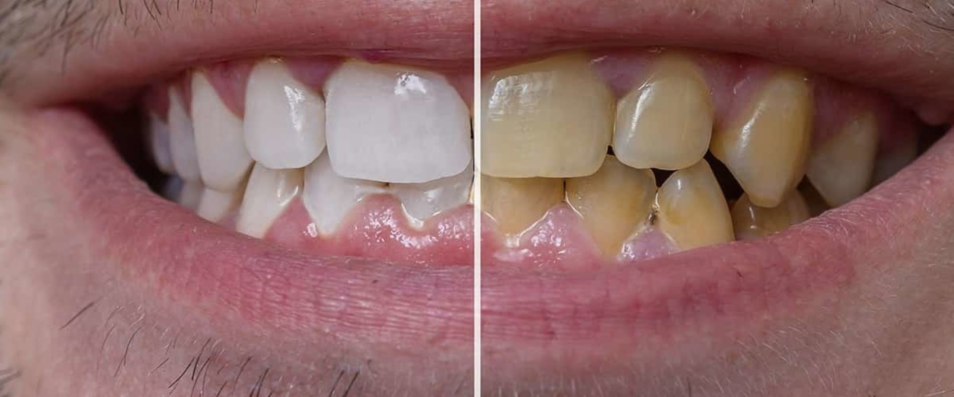 how-do-you-whiten-yellow-veneers