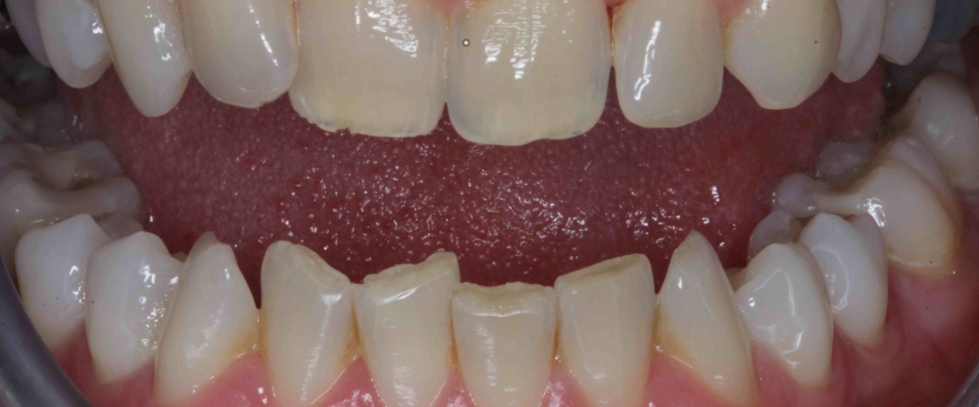 How Many Veneers Do You Need for a Full Set?