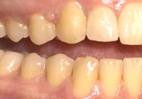 Can veneers turn yellow? Expert advice on how to keep your teeth white