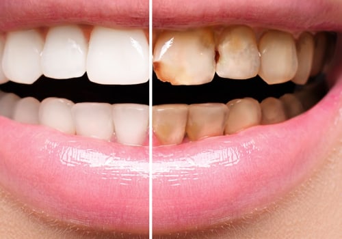 Does Replacing Veneers Damage Your Teeth?