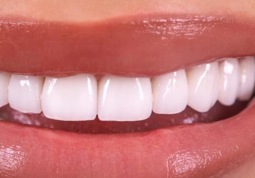 Are Dental Veneers Worth It? A Comprehensive Guide