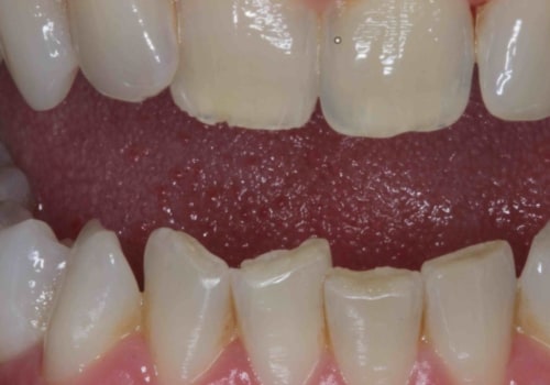 How Many Veneers Are Needed for a Full Set of Teeth?