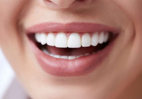 Can You Get Veneers on Top Teeth Only?