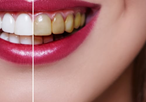 Do Veneers Turn Yellow? - An Expert's Perspective