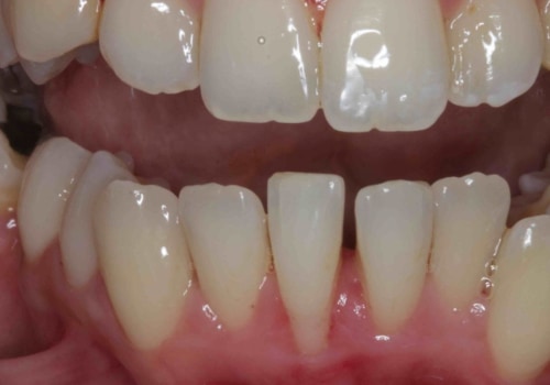 Do veneers change color over time?