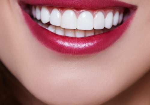 How Many Veneers Do You Need for a Perfect Smile?