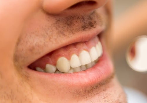 Do Veneers Need to be Replaced Every 10 Years?