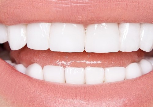 How Many Veneers Do I Need for a Perfect Smile?