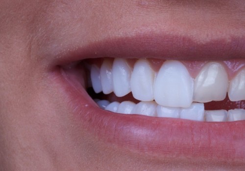 How Long Do Permanent Veneers Last?