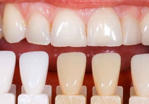 Are Dental Veneers Painful? An Expert's Perspective