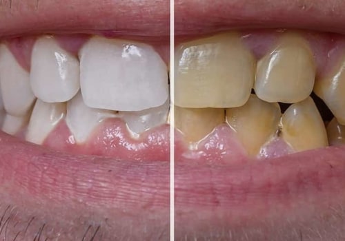 How to Whiten Yellow Veneers: Expert Tips