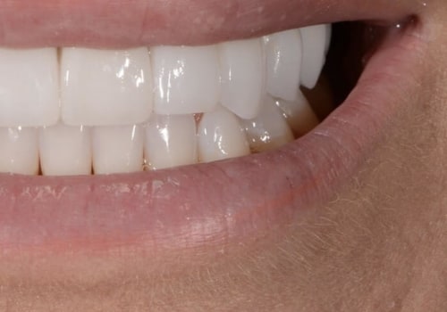 Can Veneers Cause Health Issues? A Comprehensive Guide